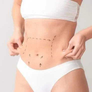 Liposuction